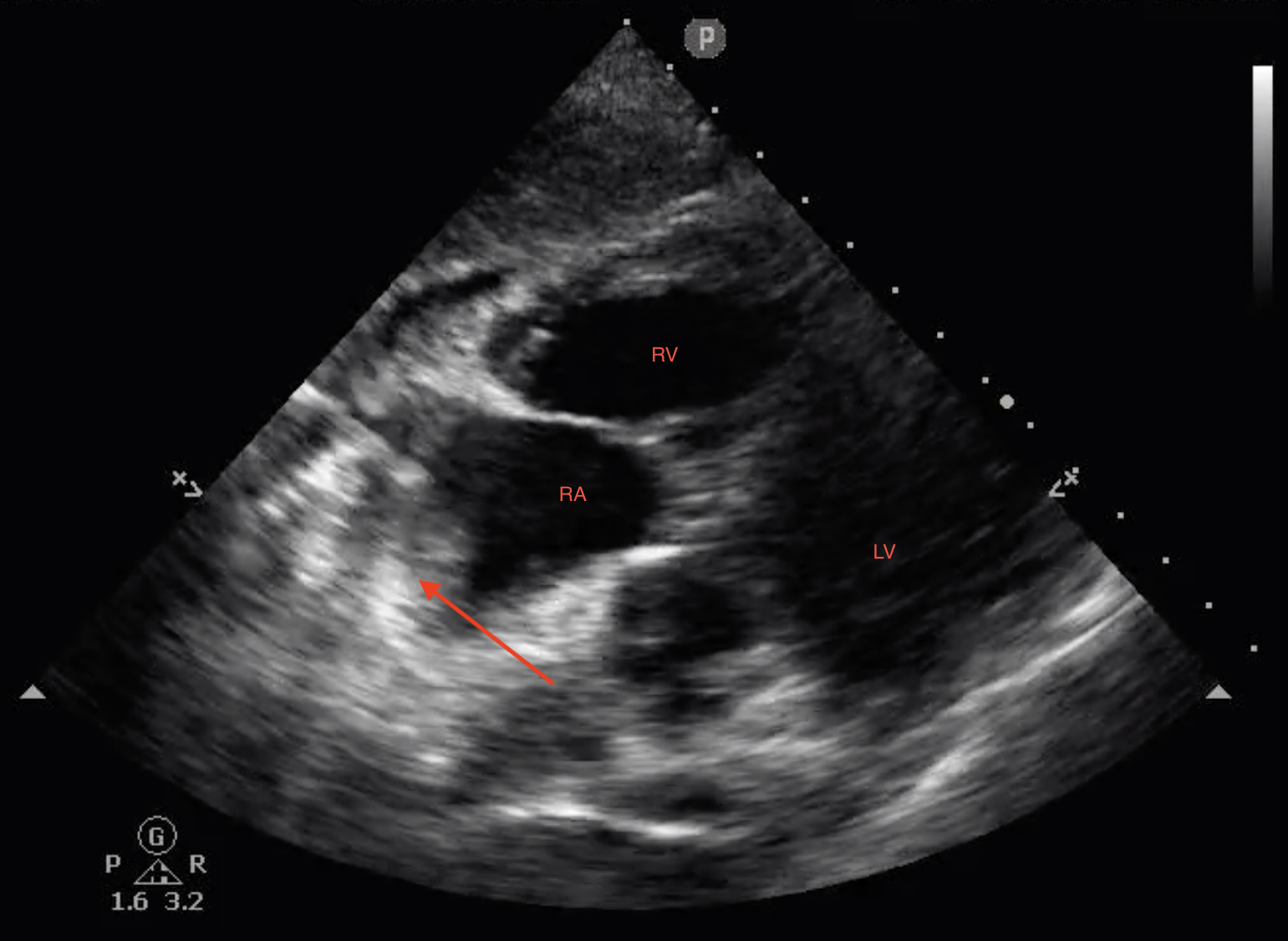 FIGURE 1: Click to enlarge. Catheter tip at the cavoatrial junction