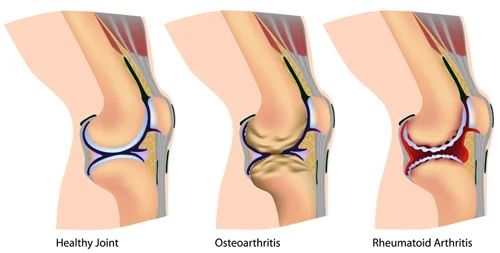 Arthritis.jpg