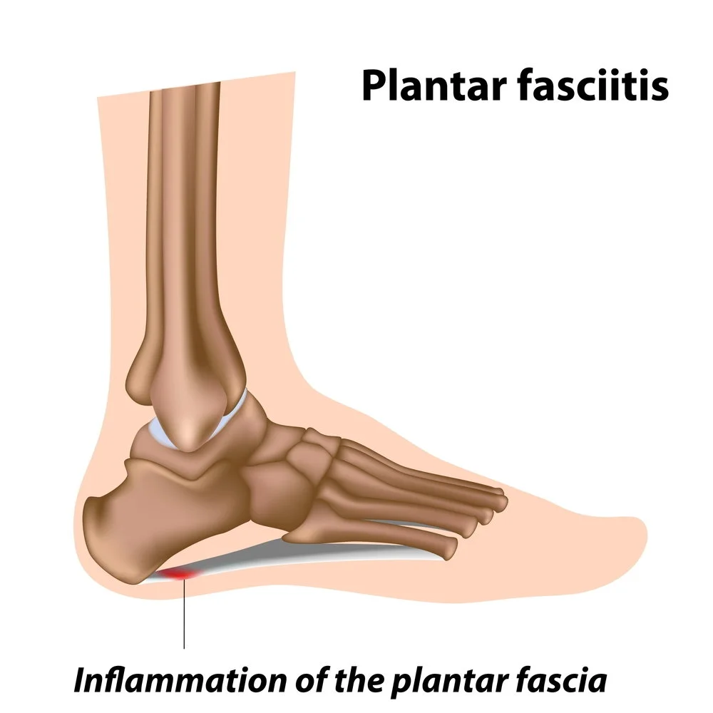 Plantar-Fasciitis-Diagram-2.jpg