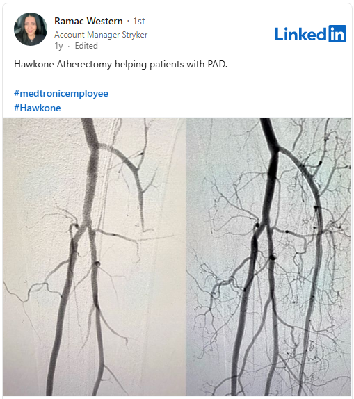 Peripheral arterial disease
