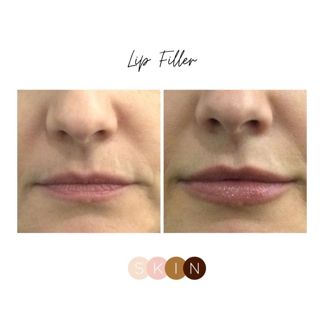 Christmas lips!! This beautiful pair of lips were treated with filler to add volume, recreating a gorgeous, plump pout! We still have a few appointments available before we close for the holidays, call to book! #hydrating