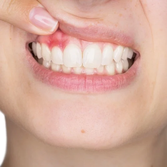 sore-gums.jpg