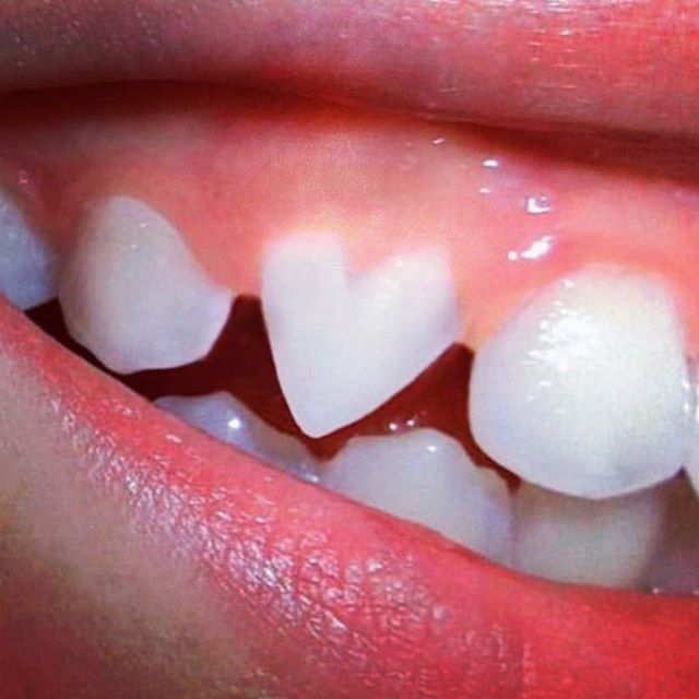 Smile, it&rsquo;s the key that fits the lock of everybody&rsquo;s heart ❤️ Happy Valentine&rsquo;s Day!! #teeth #love #dentist #invisalign #cosmeticdentistry #cheshire #valentines #heart