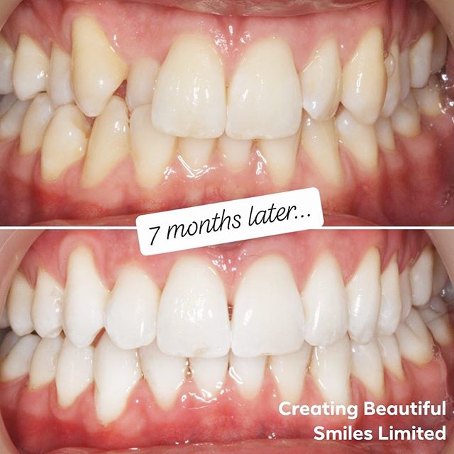 Making dreams a reality in just 7 months!! This recent completed case was achieved using solely Invisalign &amp; teeth whitening. 
For more information on how we can start you on your journey to the perfect smile call 01925752209 or email enquires@cr