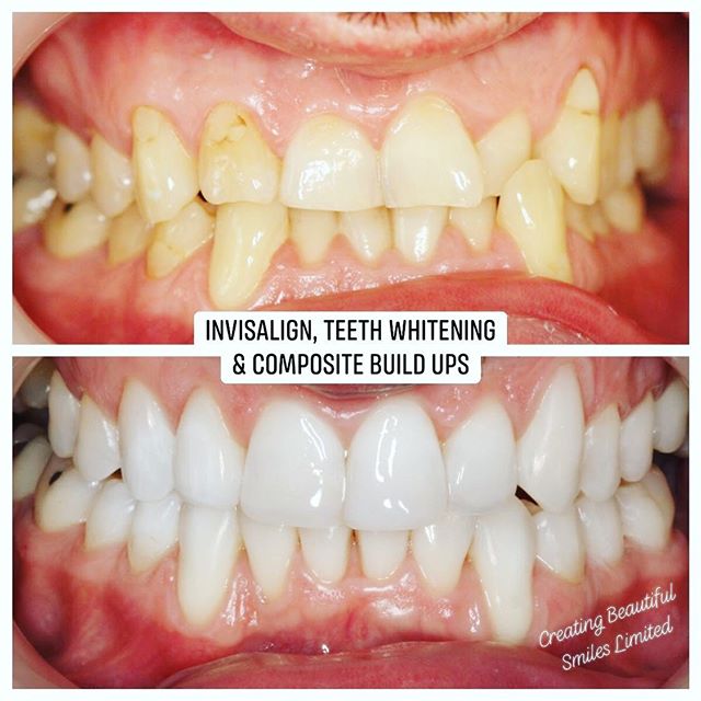Changing smiles, changing lives... ✨🦷✨ This patient came in unhappy with the colour, size and shape of his teeth. 
After a course of a year he got the smile he always wanted having had Invisalign, teeth whitening and free-hand composite build ups.

