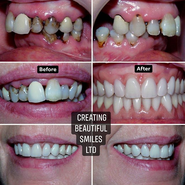 ✨ TRANSFORMATION TUESDAY ✨

This brave lady came in following long-term dental neglect due to an ongoing fear of the dentist. She had longstanding chronic periodontal disease and severely decayed teeth with failing crowns and bridges.

After a thorou