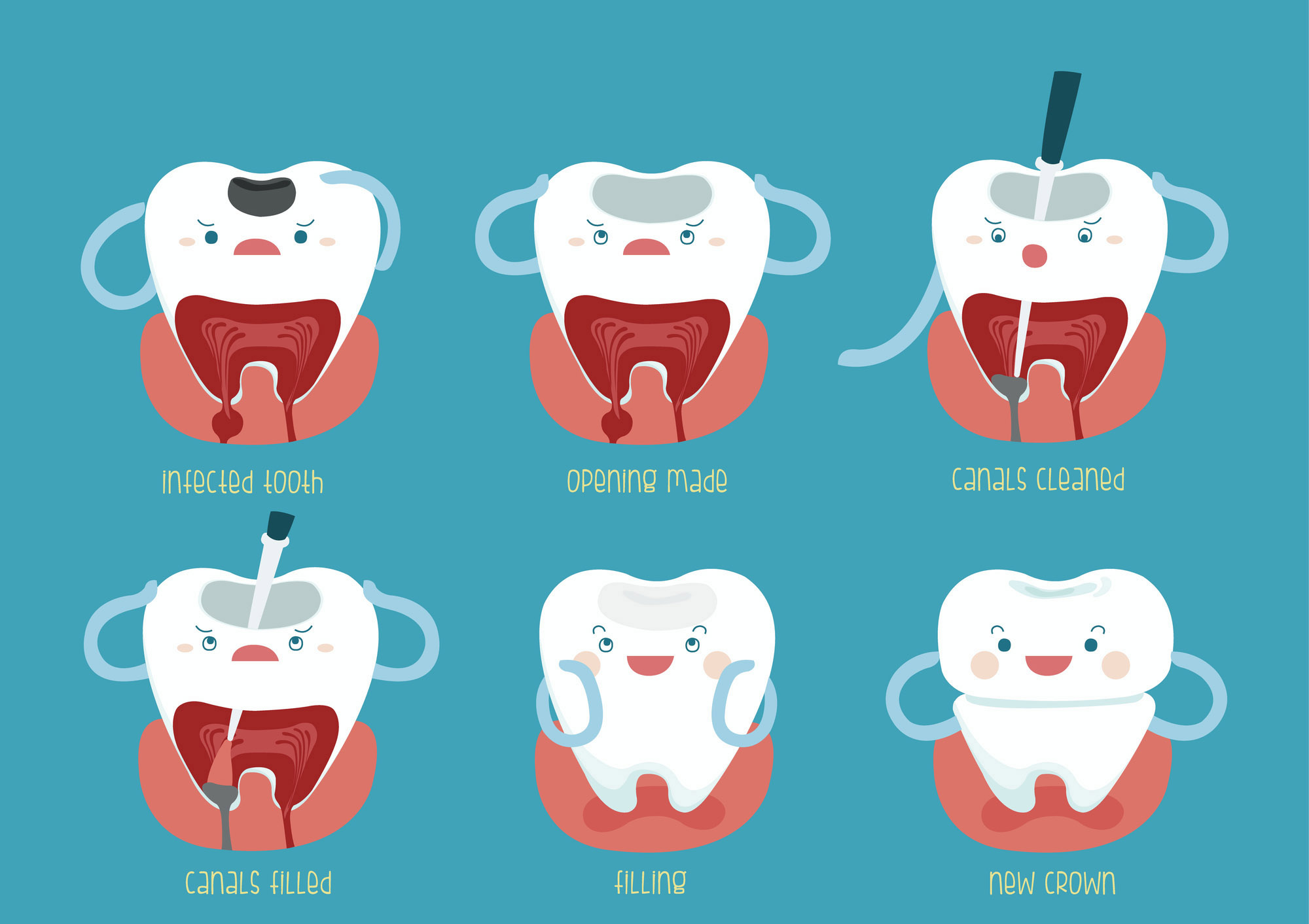 root canal