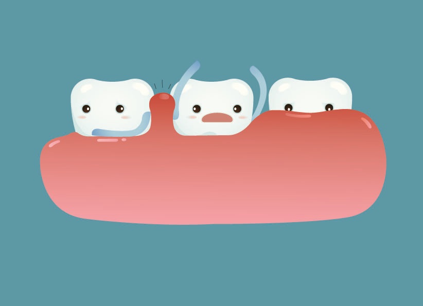 gum treatment (gingivitis, periondontitis)