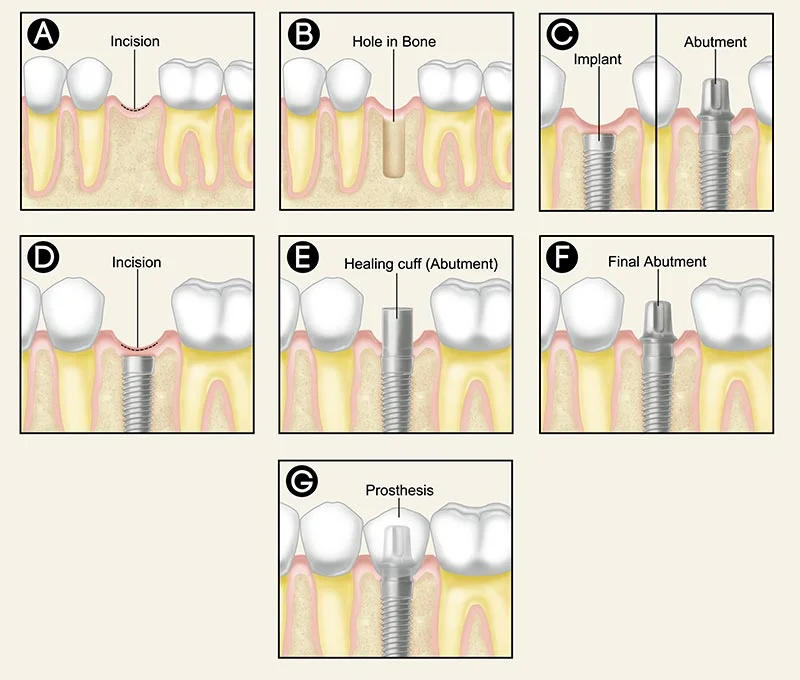 dental-implants-procedure.jpg
