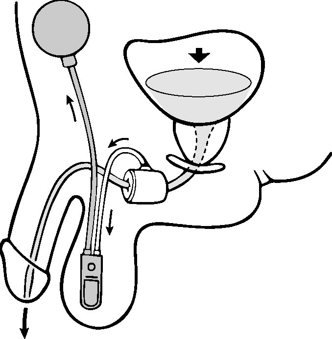 Hydraulics of Artificial Urinary Sphincter