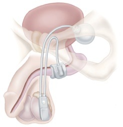 Schematic of Single Cuff Artificial Urinary Sphincter