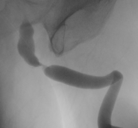 Urethral Stricture Disease: Improving Patient’s Quality of Life with Reconstructive Urology