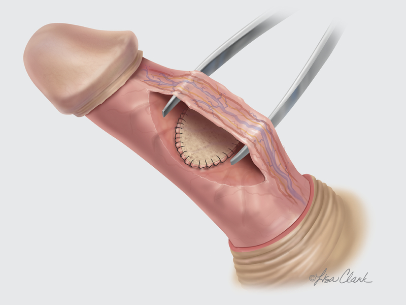 Grafting Procedure 