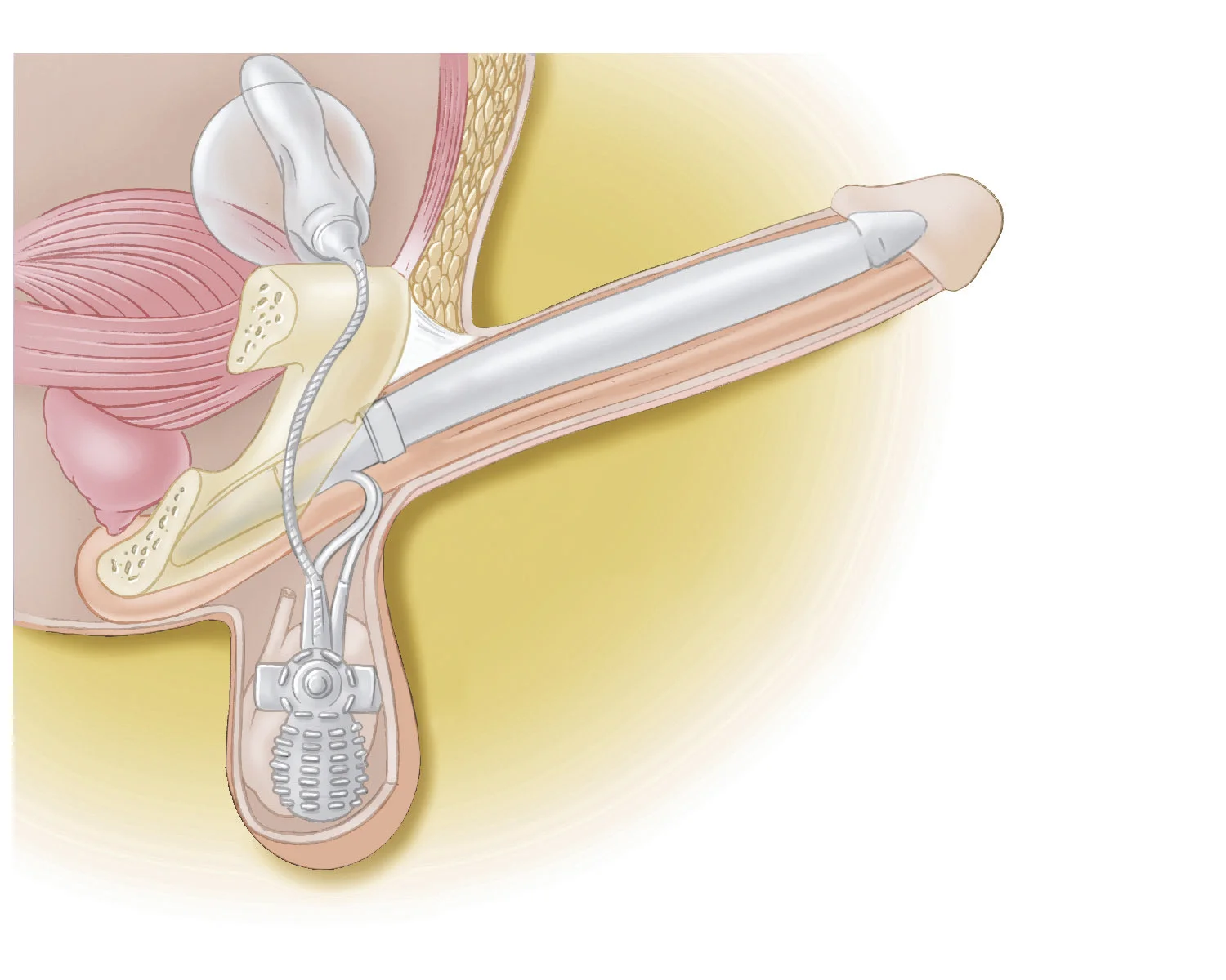 Penile Prosthesis 