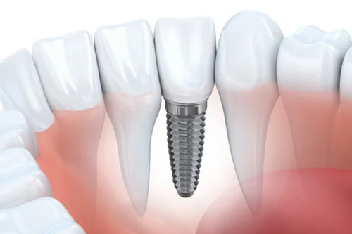 implant.jpg