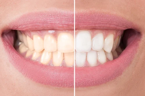 whitening.jpg