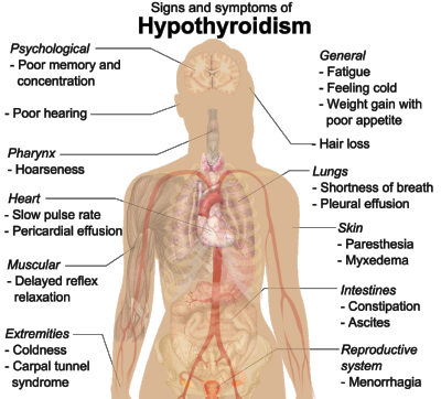 Hypothyroidism.png