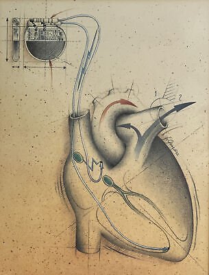 pacemaker-art3.jpeg