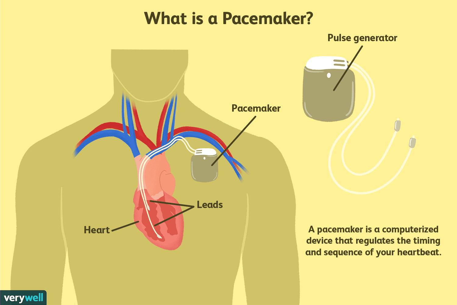 pacemakers-what-you-should-know-1745231_v2-da71dbec46b345308dd2fcbb65cc638b.png