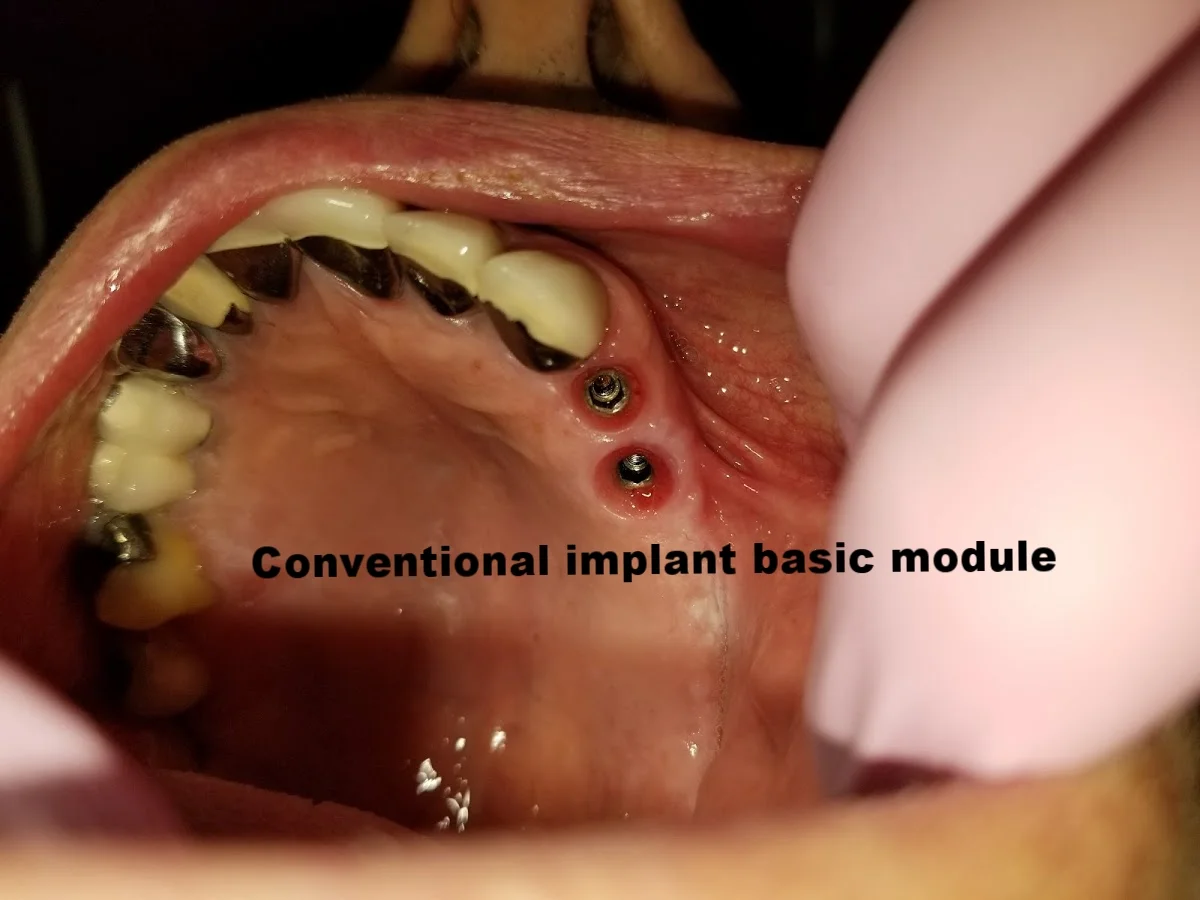 conventional implants.jpg