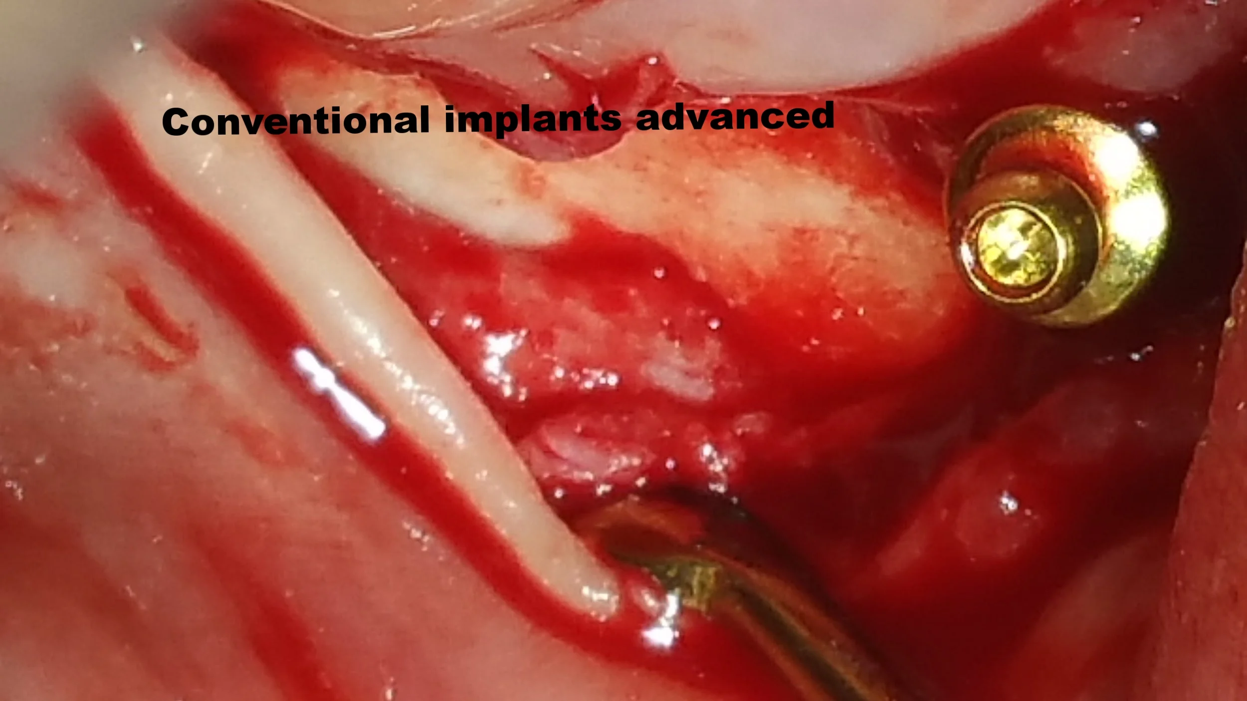 Conventionalimplantadvanced.jpg
