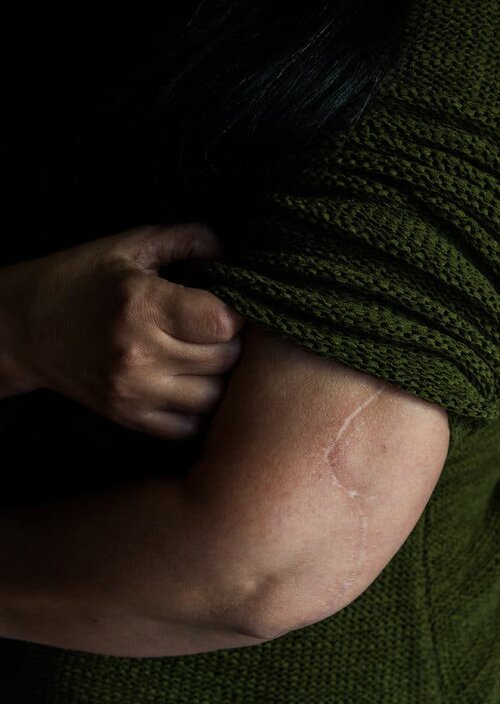 Ms. Helfer’s abusive relationship with her husband culminated one morning in July 2014, when he stabbed her more than a dozen times. She can still count the scars. Credit Alex Flynn for The New York Times