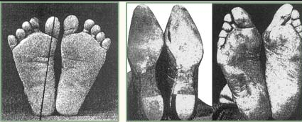 These figures show the result of improper footwear to your feet.