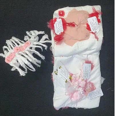 Thymoma by Brianna Brett, courtesy CQUniversity Australia.