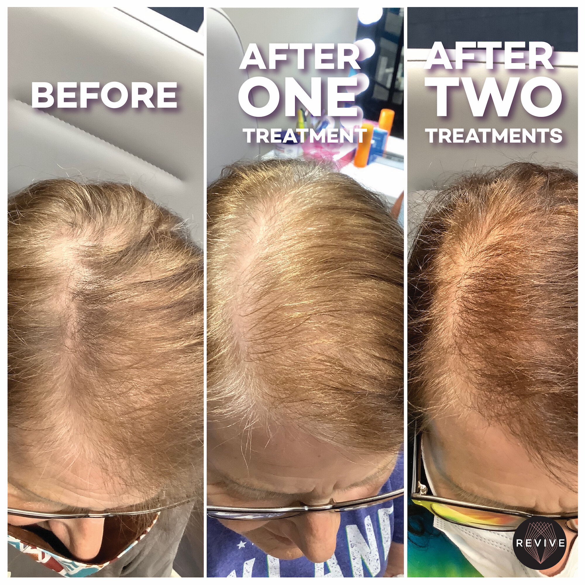 PRP Hair Restoration — Revive