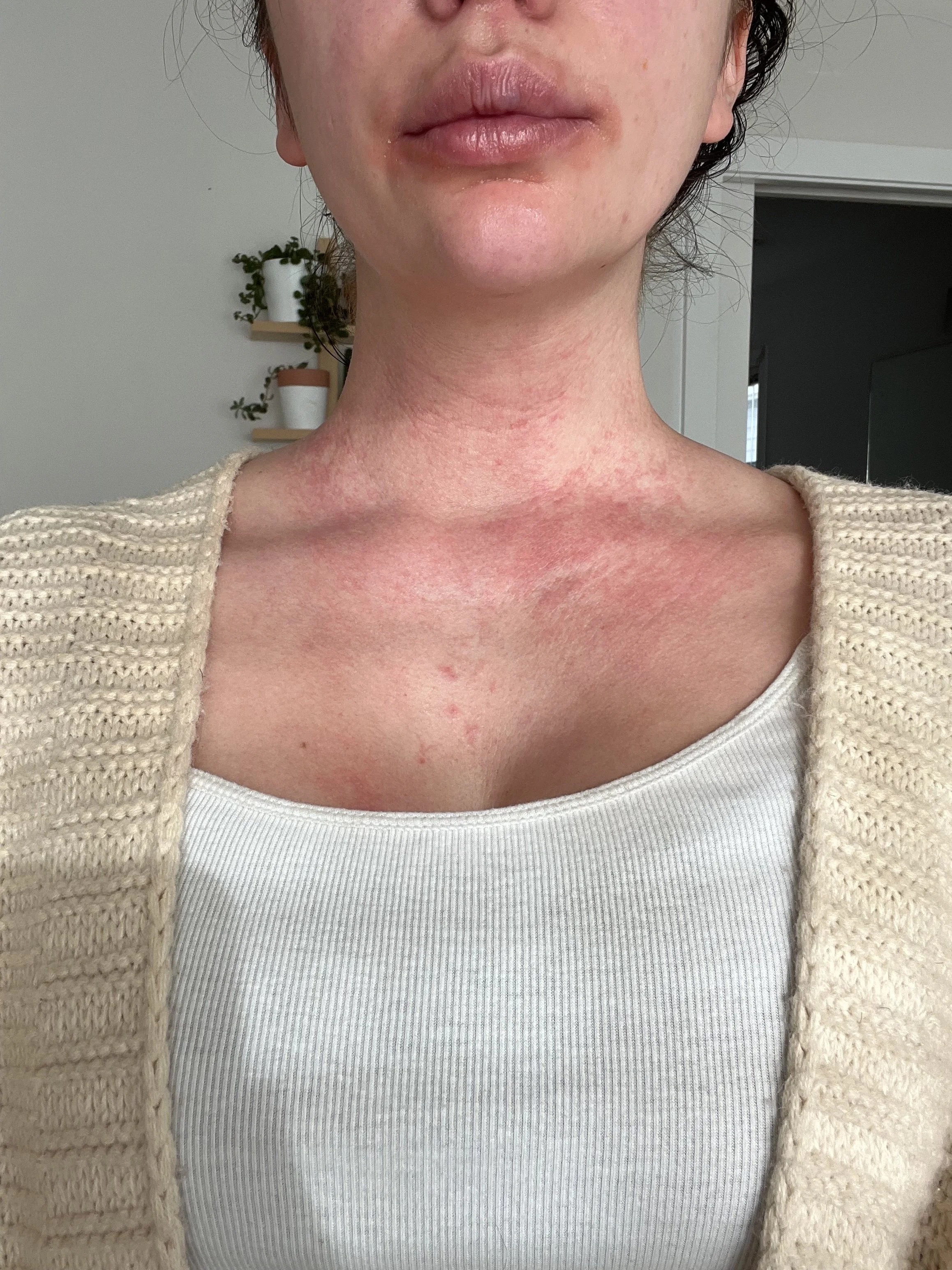 My Adult Eczema Wasn’t Just a Skin Problem
