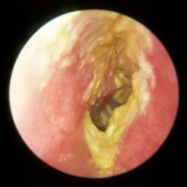 Otitis externa.jpg