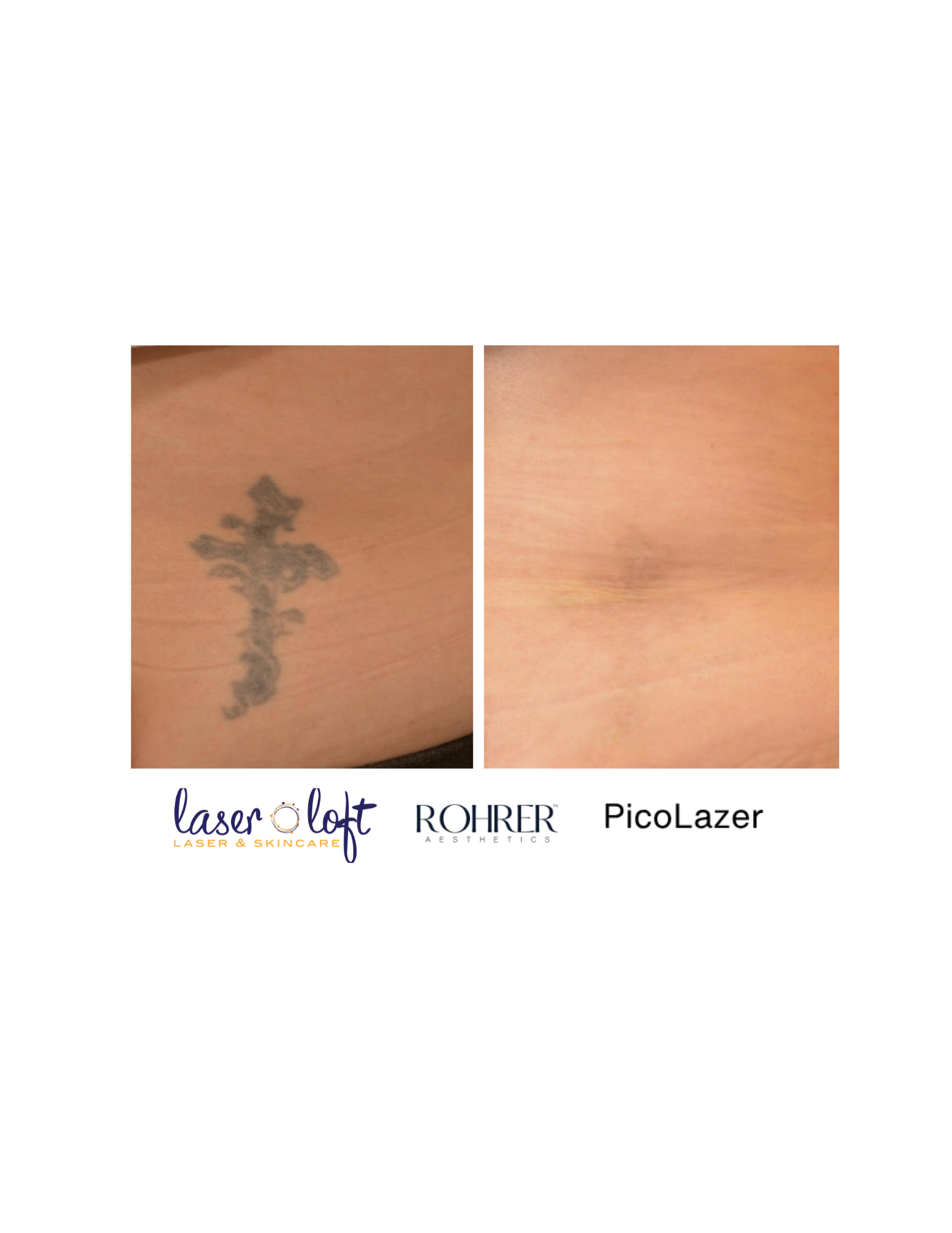 Pico Tat Removal - 3.png