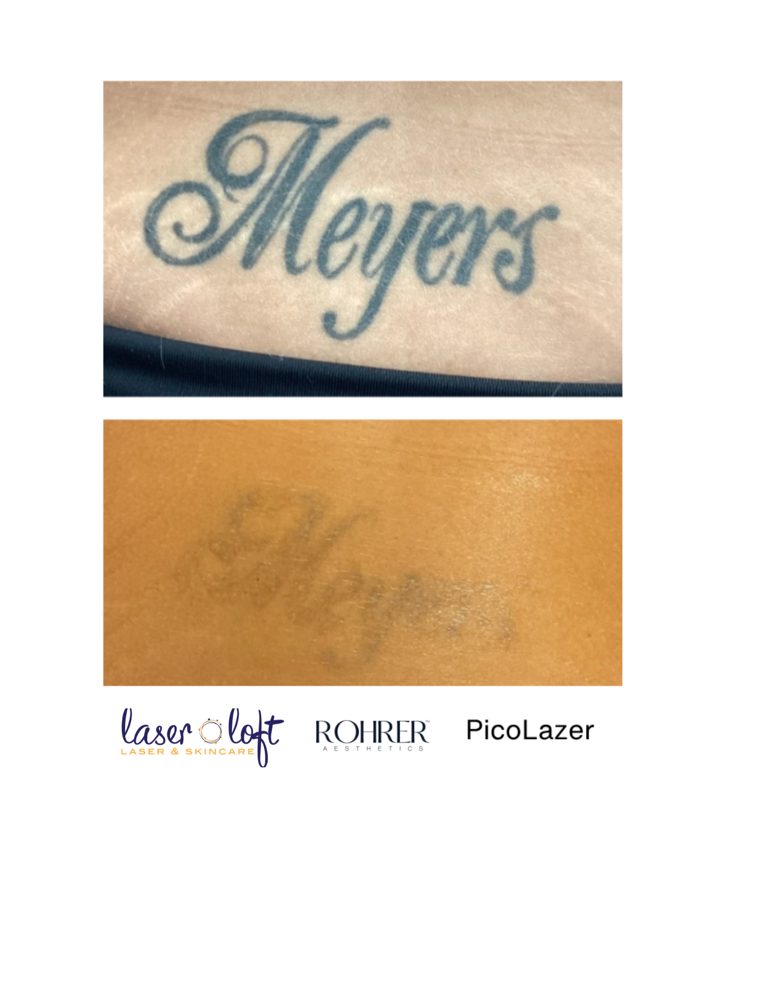 Pico Tat Removal - 4.png