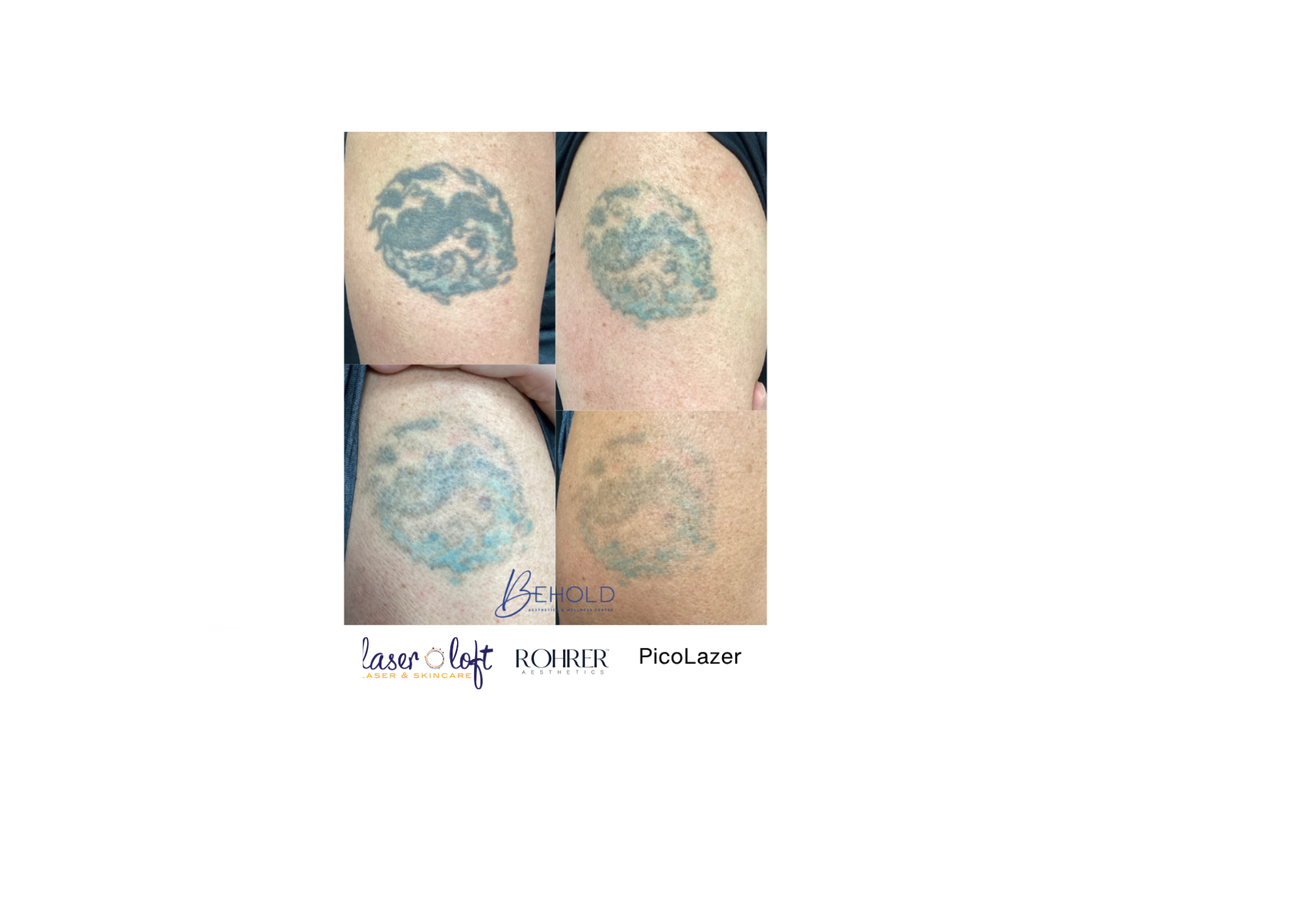 Pico Tat Removal - 2.png