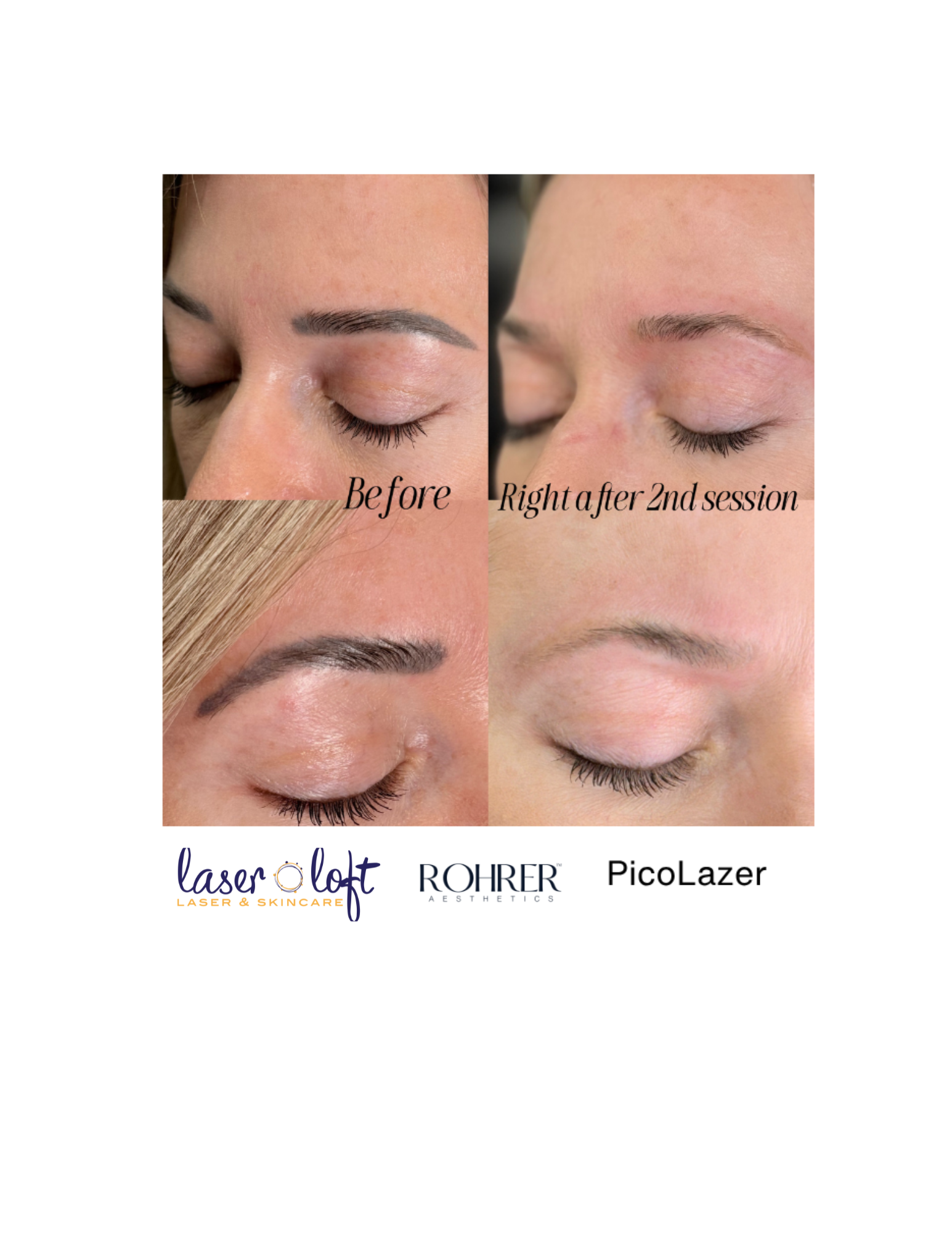 Pico Make up tattoo removal .png