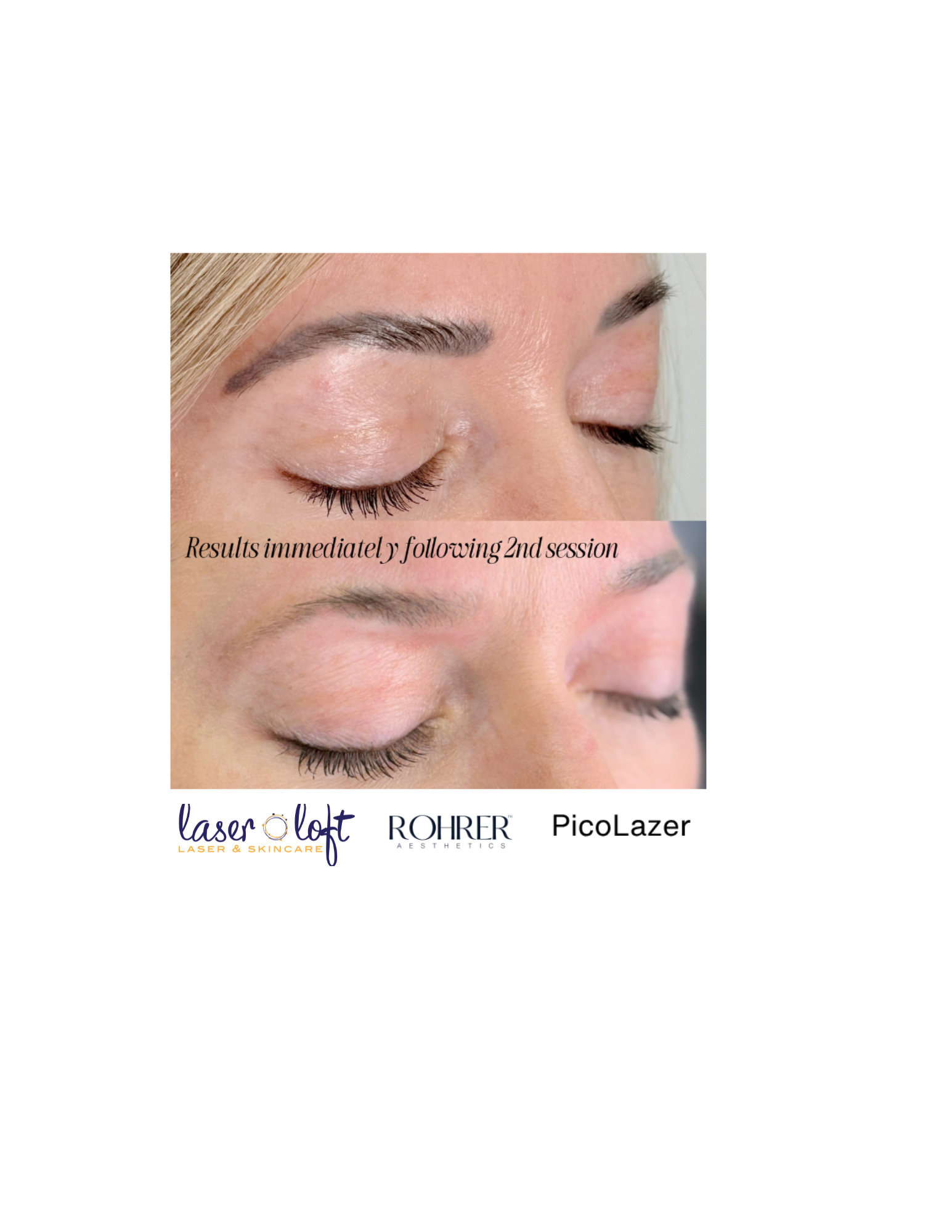 Pico Makeup Tattoo Removal  - 2 (1).png