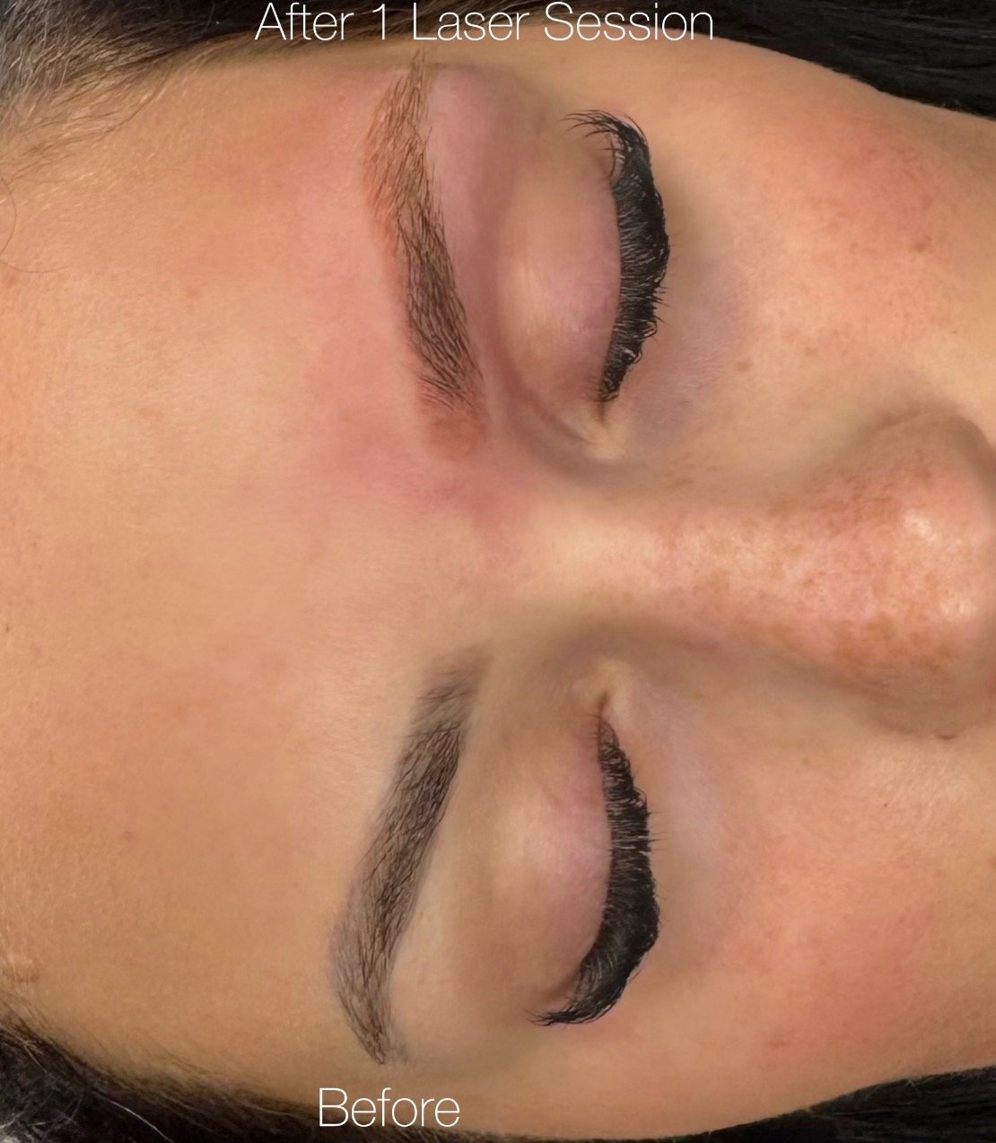 Laser vs. Saline Removal: What Actually Works for Permanent Makeup