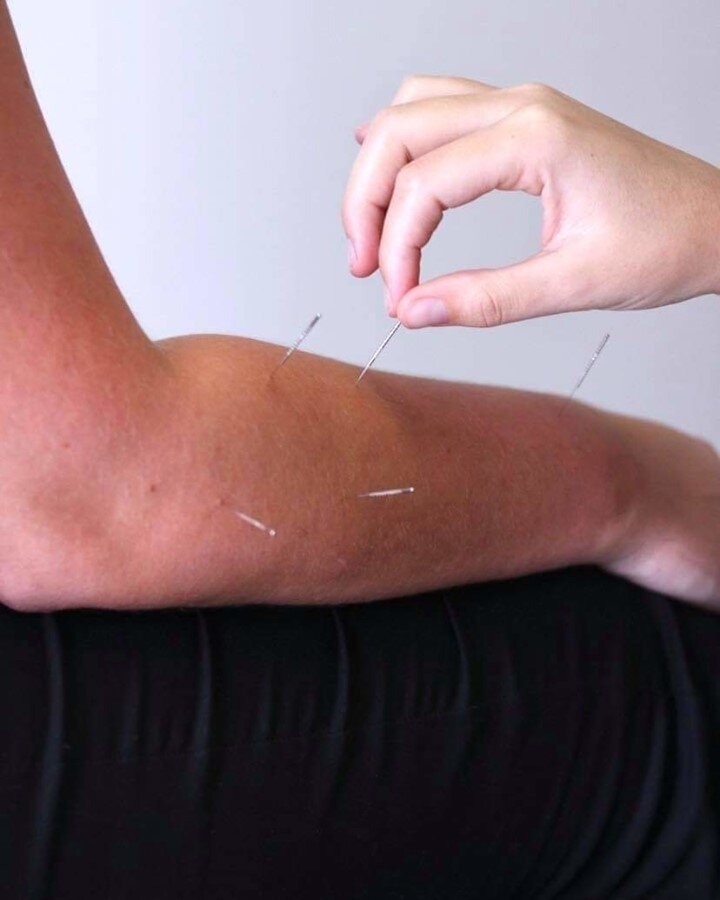 TRIGGER POINT DRY NEEDLING 

Osteo Jess getting her forearm and wrist tightness sorted out by Physio Tiana. 

Have you had dry needling? 

🙅 Or 💃 

&bull;
&bull;
&bull;
#osteopathy #osteo #osteovsphysio #healthy #health #physicaltherapy #move #func