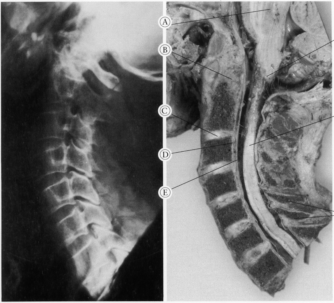 Normal Spine