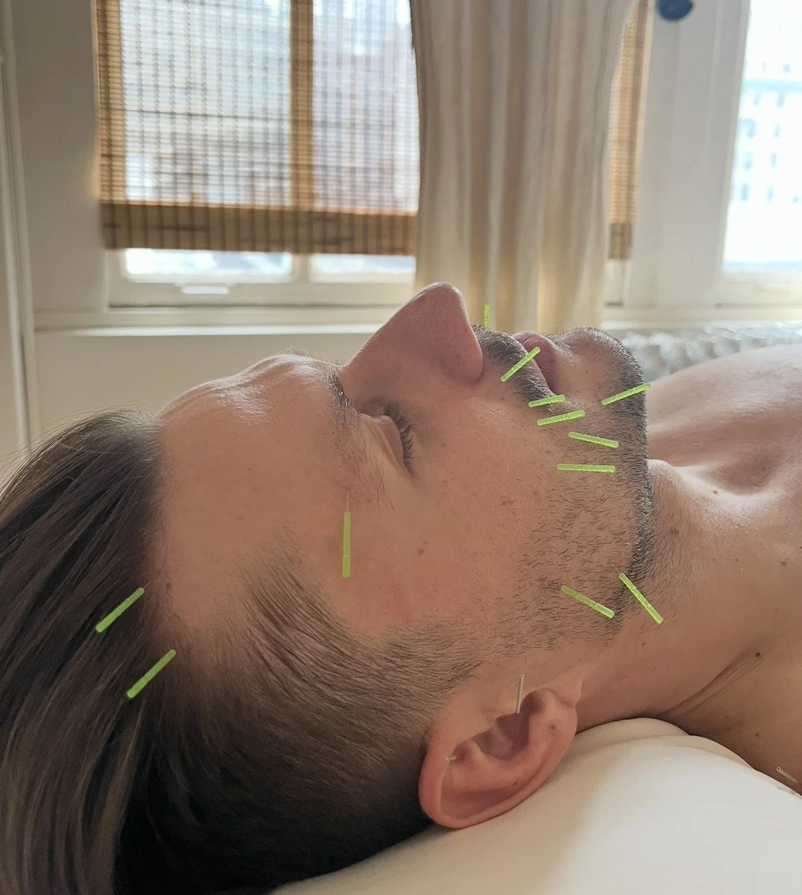 Glow From Within: Acupuncture Facial vs. Microneedling — Which One Is Right for You?
