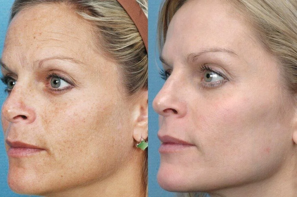 IPL-Facial-Rejuvenation-Luscious-Therapy