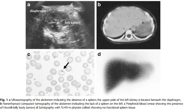 Quelle: Sporadic isolated congenital asplenia with fulminant pneumococcal meningitis: a case report and updated literature review Shigeo Iijima, Department of Pediatrics, Hamamatsu University School of Medicine, Hamamatsu, Japan