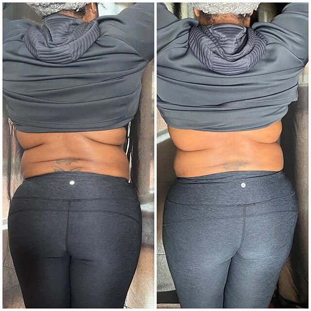 Reminiscing back to the days when we were in the studio with our beauties giving #mommymakeovers with our new #UltrasonicLipo treatments 😔. These were results from just one treatment!

Anyone else enjoying 3 meals and 14 snacks a day? 😩
#mommymakeo