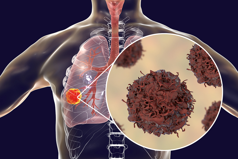 can you see blood in urine with bladder cancer