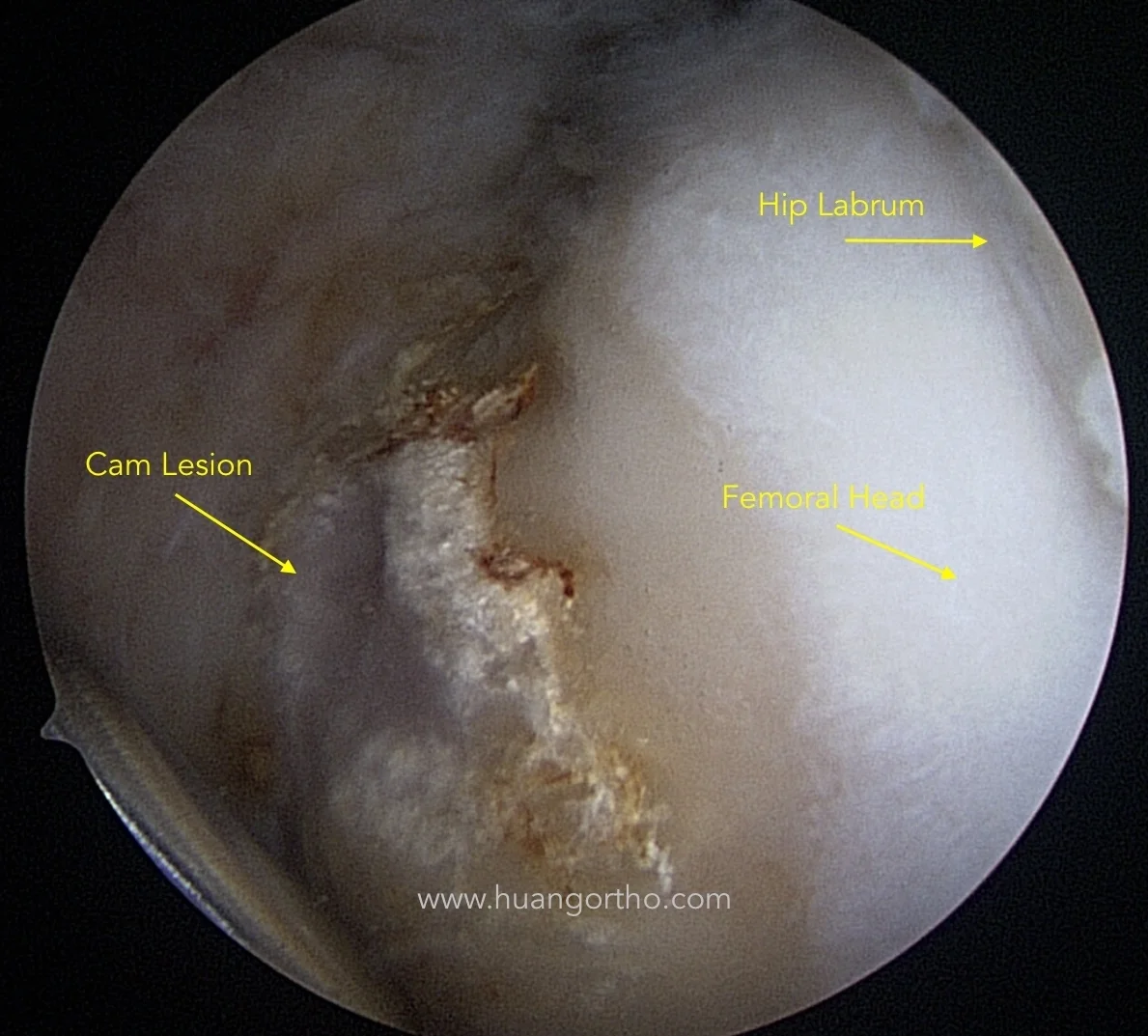 Cam lesion at the femoral head-neck junction.