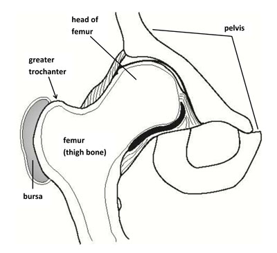 Trochanteric (Hip) Bursitis