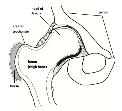 Trochanteric Bursitis.jpg