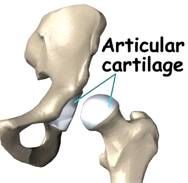 Hip Cartilage Cartoon.jpg