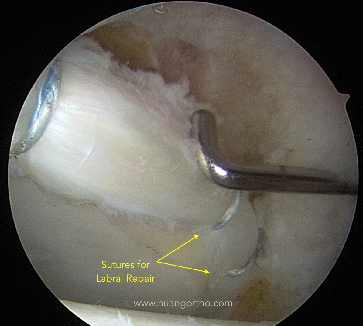 Arthroscopic probe testing hip labral repair