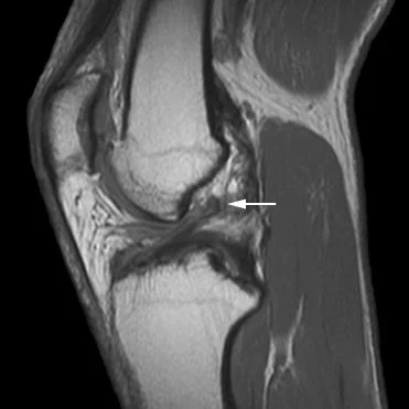 ACL tear MRI image.jpg